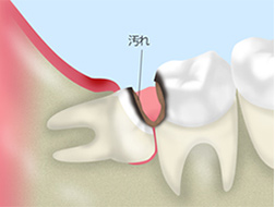 親知らずにたまった汚れ